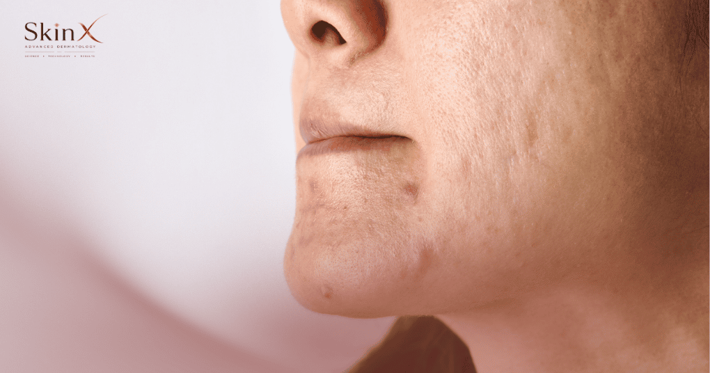 Trị sẹo rỗ bằng laser CO2 Fractional có hiệu quả trên mọi loại da không